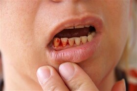 جرم دندان و خونریزی لثه زنگ خطر سلامت دهان و دندان