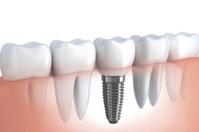 عمر مفید ایمپلنت‌های دندانی چقدر است؟