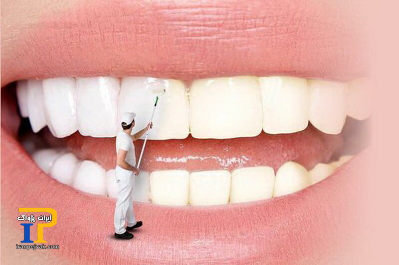 سفیدکردن دندان‌